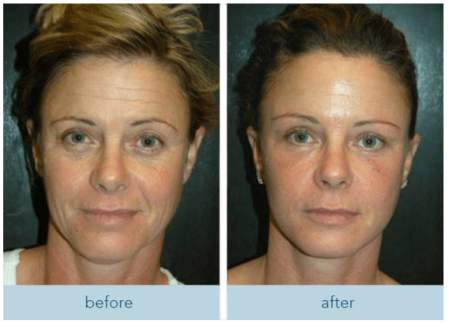 Second face comparison labeled before and after