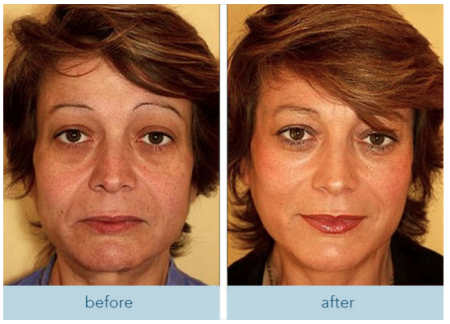 Face comparison labeled before and after